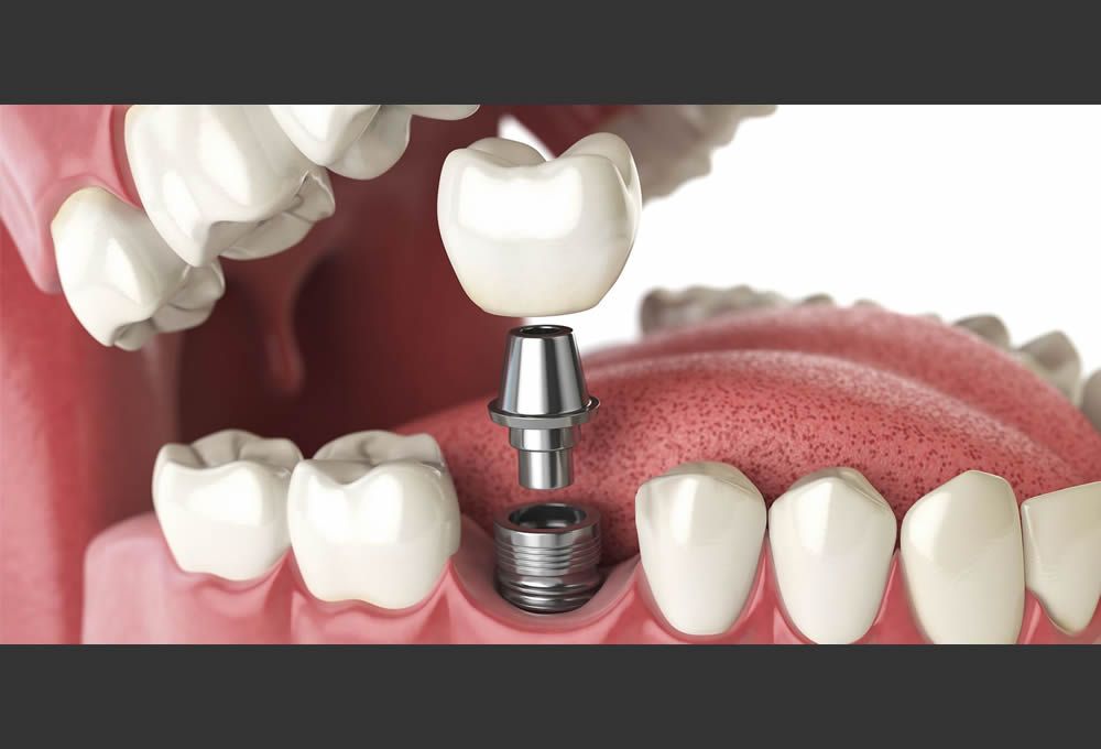 Dental Implants