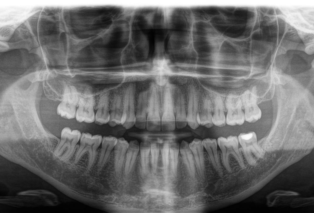 Dental X-ray