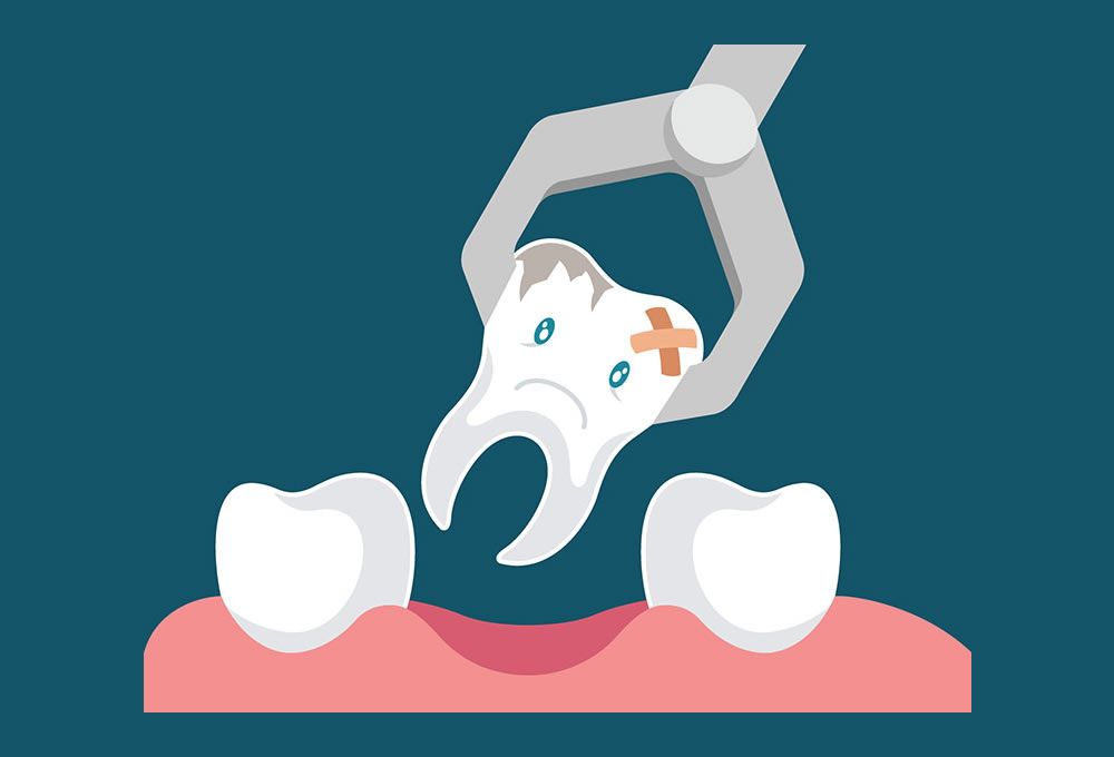 Dental Extraction